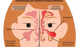 Лечение гайморита при беременности: советы и рекомендации