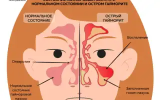 Лечение гайморита при беременности: советы и рекомендации