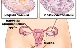 Лечение поликистоза яичников без гормонов: эффективные методы и рекомендации