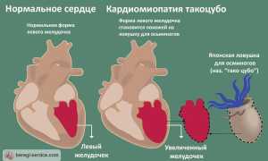 Кардиомиопатия такоцубо, или почему разбитое сердце – не миф, а реальность