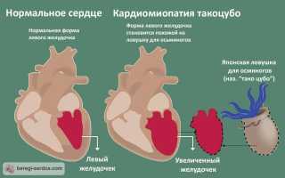 Кардиомиопатия такоцубо, или почему разбитое сердце – не миф, а реальность