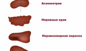 Почему пропадают родинки? Узнайте причины и последствия