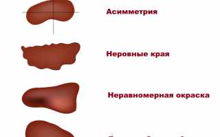 Почему пропадают родинки? Узнайте причины и последствия