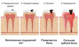Почему зубы начинают болеть от холода? Узнайте причины и решения