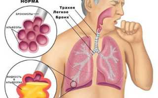 Почему от воспаления легких умирают? Причины и последствия
