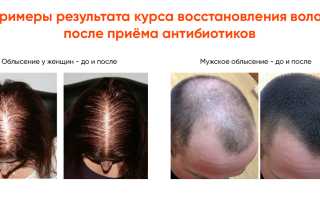 Выпадают волосы после COVID-19: почему это происходит, лечение и рекомендации