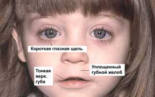 Фетальный алкогольный синдром и его причины: важные аспекты