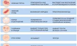 Псориаз и экзема: в чем разница между ними и их особенностями?