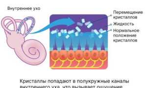 Приступы головокружения при вставании: что это значит и как с этим справиться?
