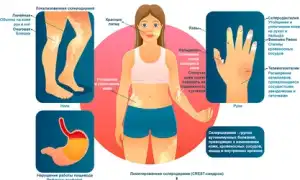 Как вылечить склеродермию, диета и здоровье кишечника для улучшения самочувствия
