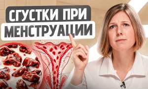 Месячные со сгустками крови — почему это происходит и что делать?