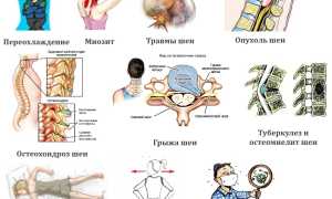 Что делать, если продуло шею и больно поворачивать? Методы лечения и рекомендации