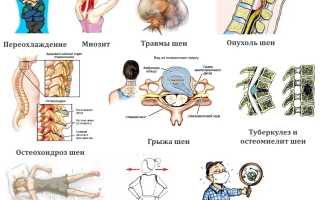 Что делать, если продуло шею и больно поворачивать? Методы лечения и рекомендации