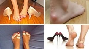 Причины вросшей мозоли