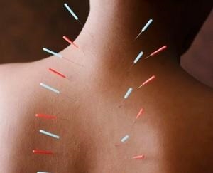 Иглоукалывание