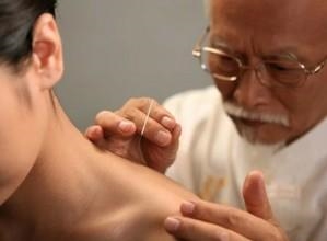 Иглоукалывание