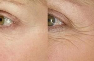 Укол ботокса