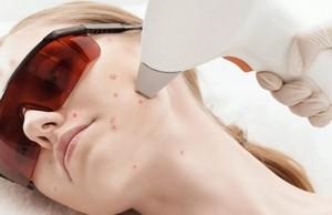 Лечение прыщей