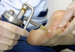 Криотерапия