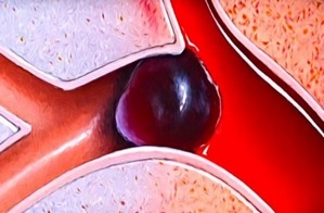 разжижения крови