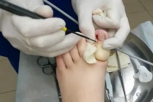 аппарат Сургитрон