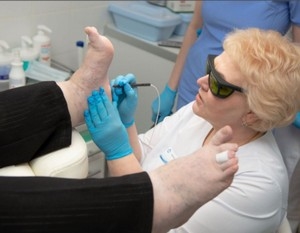 Удаление лазером