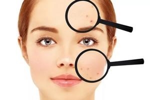 Угри на лице