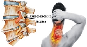 zashhemlenie-nerva