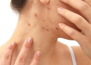 прыщи