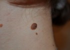 Большая родинка на шее Большая родинка на шее