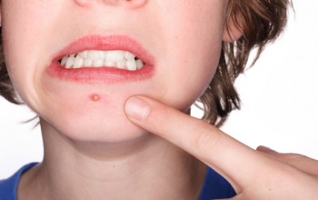 Лечение белых прыщей на коже лица Лечение белых прыщей на коже лица