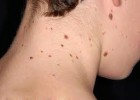 Мелкие родинки на шее Мелкие родинки на шее