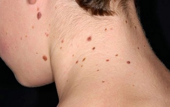 Много родинок на шее Много родинок на шее