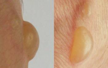 Мокрые мозоли на ногах Мокрые мозоли на ногах