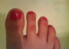 Мозоль на пальце ноги у женщины Мозоль на пальце ноги у женщины