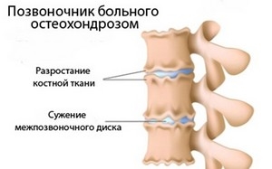 лечение остеохондроза