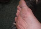 Подошвенная мозоль на ступне Подошвенная мозоль на ступне