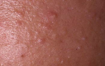 Причины появления белых прыщей Причины появления белых прыщей