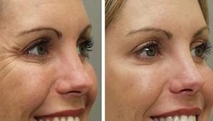 Укол ботокса