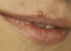 Родинка на кайме губ Родинка на кайме губ