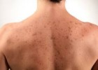 Родинка на спине у мужчины Родинка на спине у мужчины