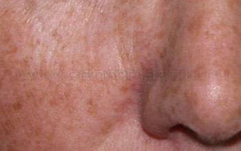 Старческие (возрастные) плоские родинки Старческие (возрастные) плоские родинки