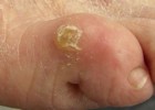Сухая мозоль на мизинце Сухая мозоль на мизинце