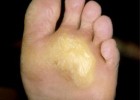 Сухая мозоль на ступне Сухая мозоль на ступне