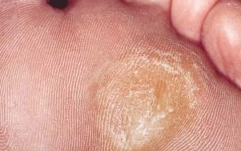 Сухие мозоли на ногах Сухие мозоли на ногах