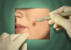 Удаление родинок на щеке Удаление родинок на щеке